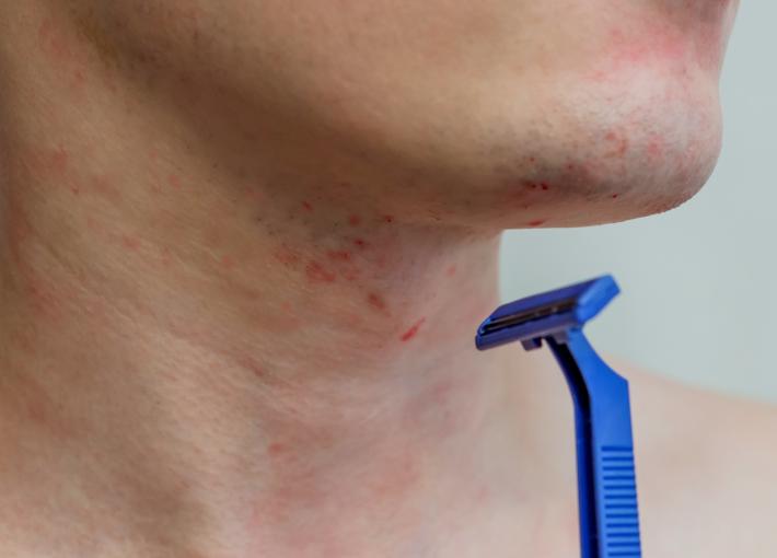 Navigate your teen’s acne journey